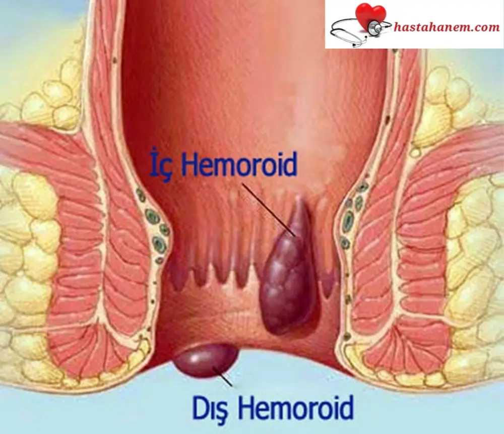 Hemoroid ( Basur) Belirtileri, Ameliyatı ve Tedavi Yöntemleri